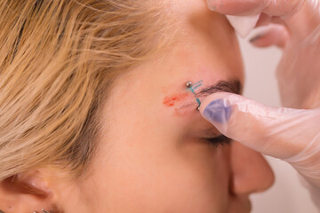 Professional placing the jewel of piercing on the temple on the head with ball. Tragus type.