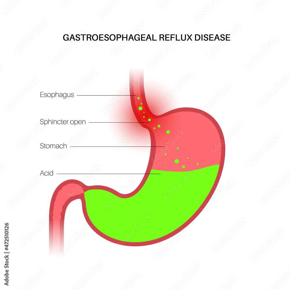 Sticker Gastroesophageal reflux disease