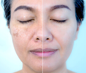 Retouched image before and after spot melasma pigmentation facial treatment on middle age asian...