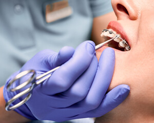 Close up of dentist hand putting elastic rubber band on patient brackets. Woman with wired metal...