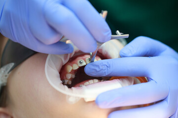 Installation of braces on the upper teeth. Treatment by an orthodontist. Focus on braces. Selective Sharpness.