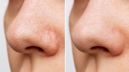 Close-up of woman's nose with blackheads or black dots before and after peeling and cleansing the face isolated on a white background. Acne problem, comedones. Cosmetology dermatology concept - obrazy, fototapety, plakaty