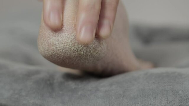Dry problem skin on the heels of a person's foot, close-up. Cracked skin, macro