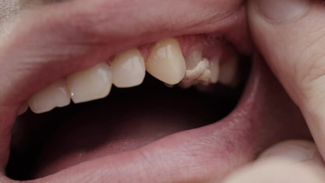 Temporary fillings on teeth after pulpitis treatment. Temporary fillings in dentistry, macro