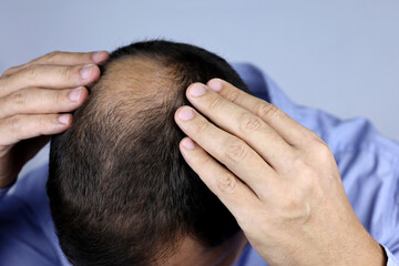 Fototapeta premium Man concerned about hair loss. Baldness, male hands on a bald