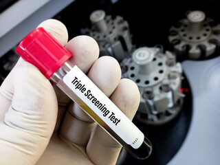 Scientist holding blood sample for Triple screening test(AFP, beta HCG and uE3). It can help our baby may be at higher risk for certain birth defects