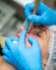 Removal of red spots, rosacea, blood vessels, on the face of a Caucasian woman. Laser apparatus. 