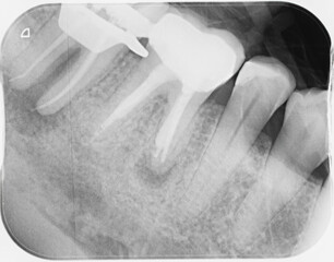 X-ray of four human teeth, two molars have been heavily filled and had root canal treatments following an infection, abscess. Infections visible at end of roots showing further treatment required. - 472703580