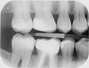 X-ray of four upper and four lower human teeth. Some of the teeth have been heavily filled and some have had root canal treatment following an infection, abscess. Endodontic therapy on several teeth. - 472703581