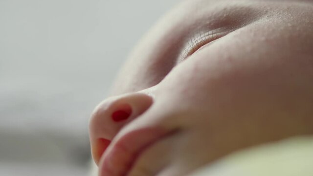  Macro shot of a sleeping childs face affected by diathesis. Troubled face skin of a small caucasian baby.   Childs face with skin defect. Closeup of babies cheecks. Close up of infants face