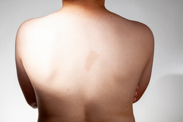 A large light brown cafe au lait spot known as birth mark on the inter scapular region of a...