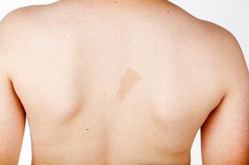 A large light brown cafe au lait spot known as birth mark on the inter scapular region of a...