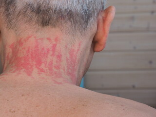 Fototapeta premium red spots allergy irritation on a man's neck