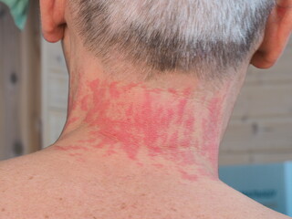 Fototapeta premium red spots allergy irritation on a man's neck