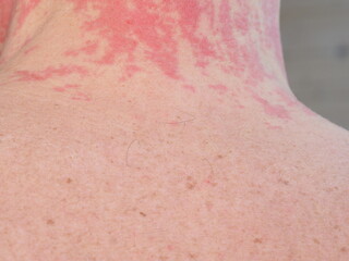 red spots allergy irritation on a man's neck