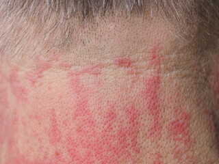 Fototapeta premium red spots allergy irritation on a man's neck