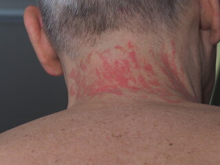 Naklejka premium red spots allergy irritation on a man's neck