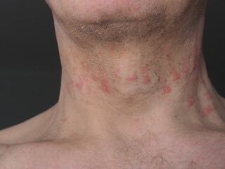 red spots allergy irritation on a man's neck