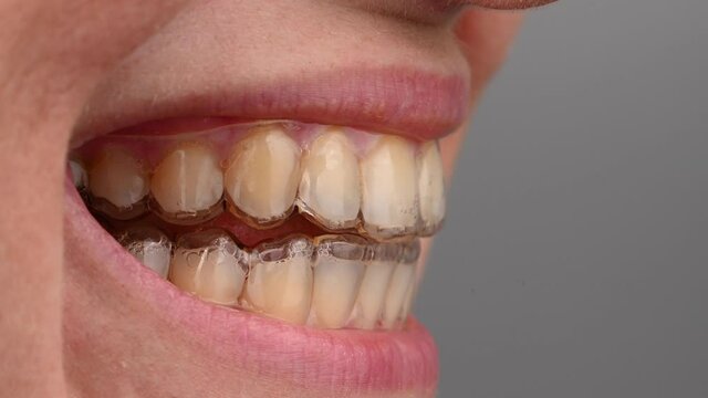 Close-up of a caucasian woman smiling with aligners on her teeth. Macro.