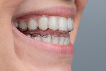 Fototapeta premium Close-up of a caucasian woman smiling with aligners on her teeth. Macro.