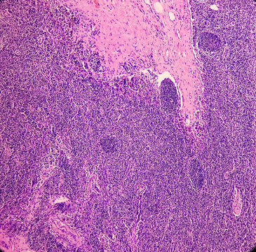 Lymph Angioma, Photomicrograph Of Lymphangioma(cystic Hygroma) Or Lymphatic Malformation, Benign Lesions,  Noncancerous, Fluid-filled Cysts That Occur In Lymphatic Vessels.