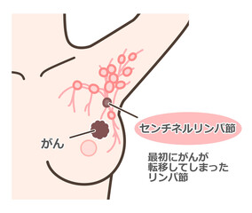 Fototapeta premium センチネルリンパ節生検の解説イラスト