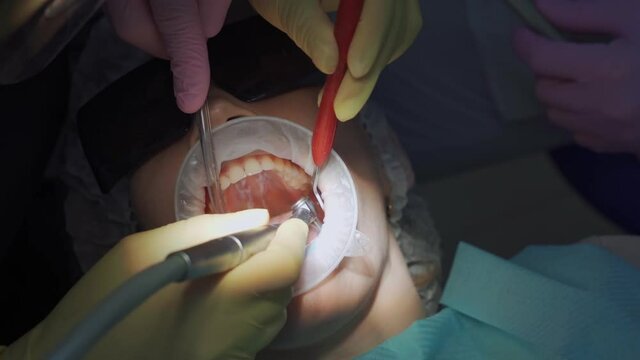 real. dentist treats patient with caries, drills tooth and installs filling
