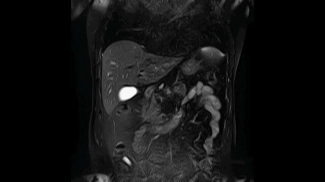 CT scan of the abdomen. Computed tomography of the gastrointestinal tract, liver and kidneys.