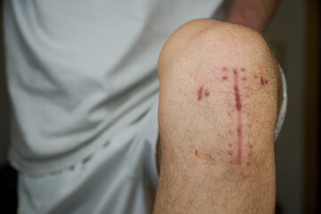 Scars after a cruciate ligament replacement on a knee