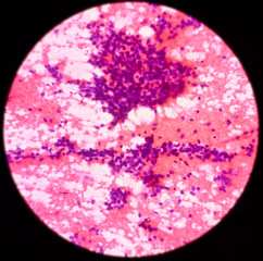Lung cancer, photomicrograph of small cell carcinoma, malignant cells, sample sapirate from lung...