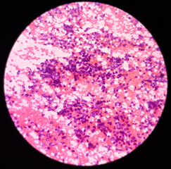 Lung cancer, photomicrograph of small cell carcinoma, malignant cells, sample sapirate from lung mass by CT guided FNA, show atypical small round cells, granular salt pepper chromatin