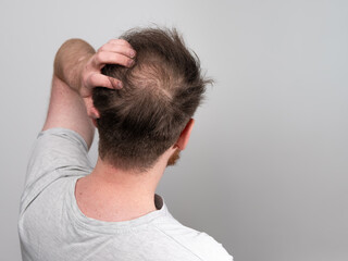 Behind view of a young balding man's head showing clear signs of balding and hair loss around the...