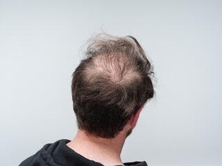 Back of a man's head with a massive bald patch showing male pattern baldness and thinning hair. Balding and hair loss concept with man iscolated on a white background with room for text. 