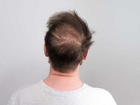 Back shot of a young balding man's head showing clear signs of balding and hair loss around the scalp. Male pattern baldness concept against a clear white background with room for text.