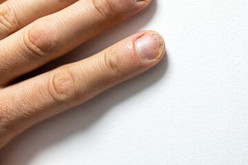 finger with Psoriatic onychodystrophy or psoriatic nails. psoriasis unguium. skin problem