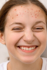 face of a teenage girl with pimples, acne on the skin, portrait of a cool happy teen girl