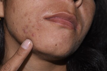 Pimples, Dark spots, freckles, dry skin on face middle age woman, Problem skincare and health concept.