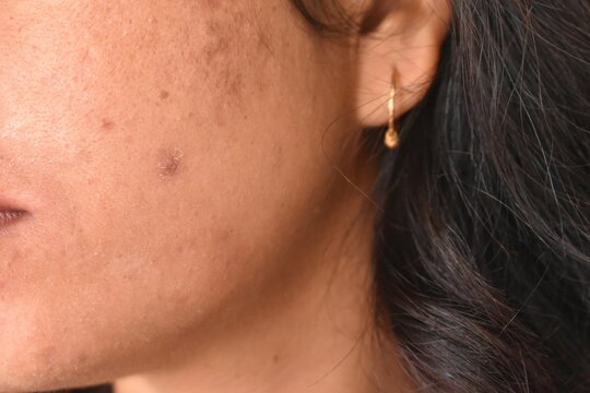 Pimples, Dark Spots, Freckles, Dry Skin On Face Middle Age Woman, Problem Skincare And Health Concept.