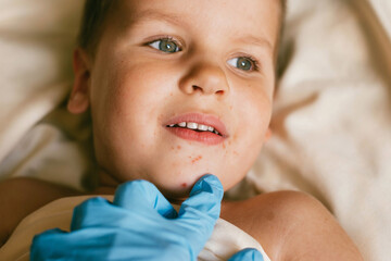 Rash of enterovirus infection picornavirus families on the face of a 3-year-old child. Medicine,...