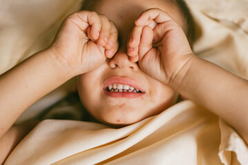 Rash of enterovirus infection picornavirus families on the face of a 3-year-old child. Medicine, health concept.