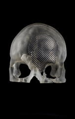 3D Printing craniomaxillofacial titanium skull implant 