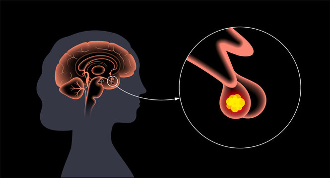 Pituitary Adenoma Cancer