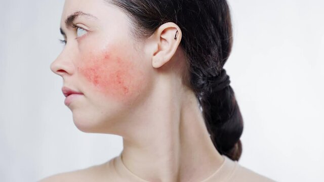 Close-up portrait of a young beautiful woman turning and showing rosacea on her cheek. White background. The concept of aesthetic skin problem