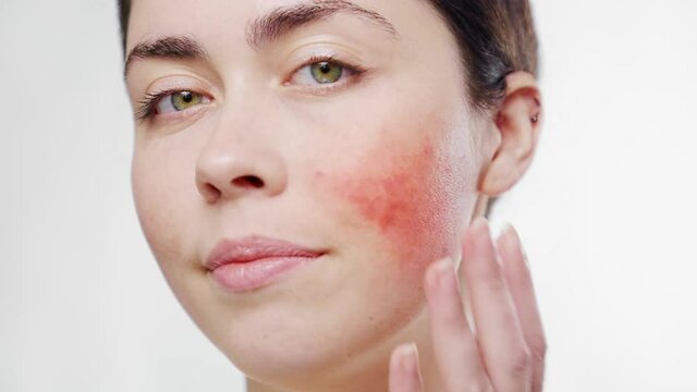 Close-up face of a young beautiful woman touching the infalammation rosacea on her cheek with her fingers. White background. The concept of couperose