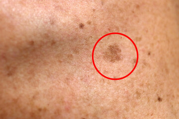 skin blemish on the back of a young caucasian girl - sun disease