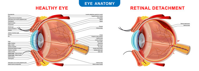Retinal Detachment, anatomical diagram of the eye. Medicinal educational information. Vector illustration.