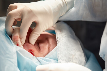 Close up of the face of a patient who is undergoing blepharoplasty. The surgeon cuts the eyelid and...