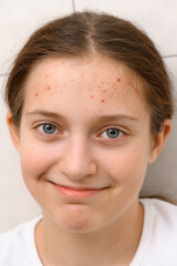 face of a teenage girl with pimples, acne on the skin, portrait of a cool happy teen girl