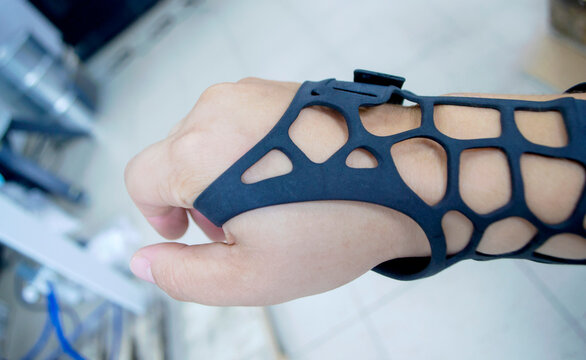 Black Orthopedic Plastic Prosthesis Printed On Powder 3D Printer On Hand. Orthopedic Gypsum Is On Arm Close-up. Multi Jet Fusion MJF 3D Printing Technology. New Modern Progressive Additive Technology.