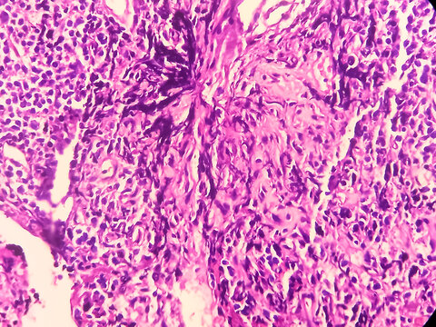 Olfactory neuroblastoma(ONB) or Esthesio neuroblastoma. Tissue from nasopharyngeal growth, light microscopic show malignant neoplasm. It's an uncommon malignant neuroectodermal nasal tumor.